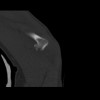 SPORK, NICO - 22.03.1976 - 02.08.2022 - CT obere Extremität - 18:01:46